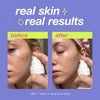 Seoul Acne Spray