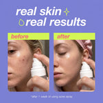 Seoul Acne Spray